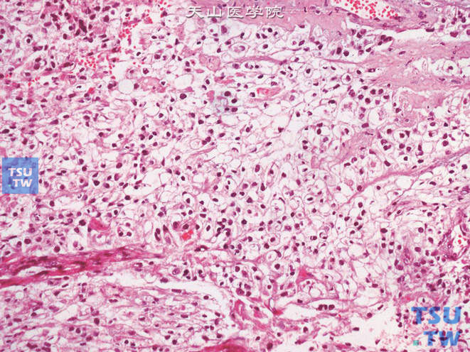 肾盂高级别浸润性尿路上皮癌，透明细胞变异型。瘤细胞胞质空亮