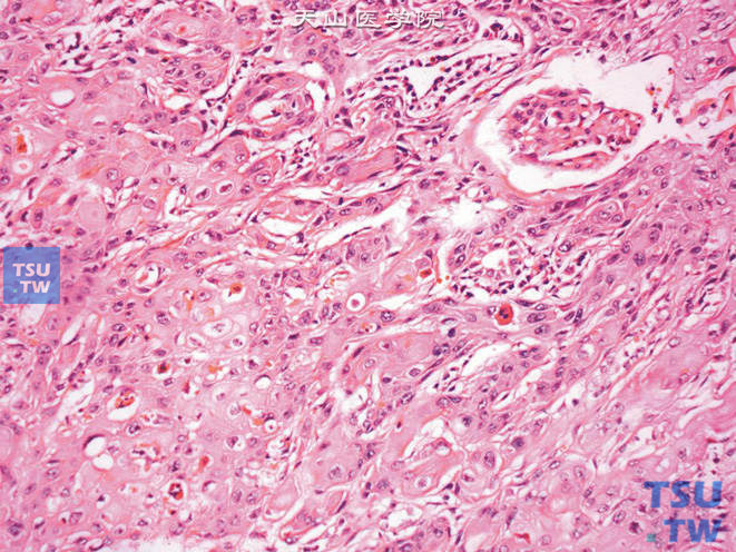 恶性肿瘤：肾盂鳞状细胞癌病理图谱