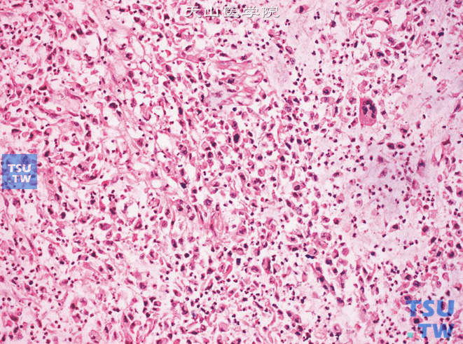 肾盂癌肉瘤，肉瘤成分细胞异型明显，可见多核巨细胞，核分裂象易见