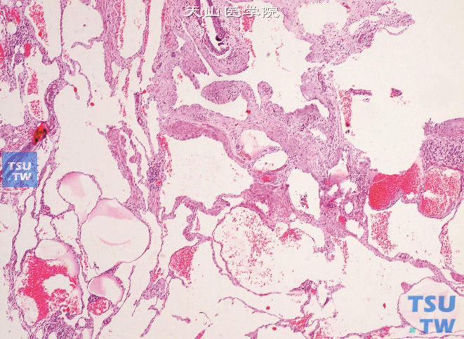 肾盂的海绵状血管瘤，上方可见少许肾盂黏膜上皮