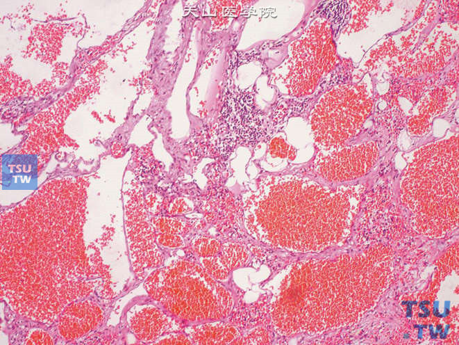 肾盂的海绵状血管瘤，腔内可见大量红细胞