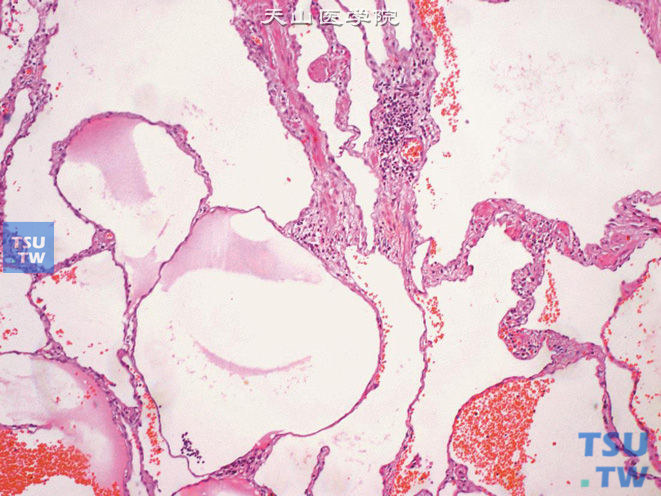 肾盂的海绵状血管瘤，示薄壁血窦，间质可见少量炎细胞浸润