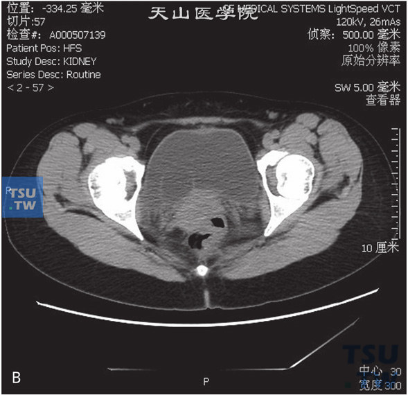 图B：CT，输尿管囊肿。女，28岁，肾积水，输尿管囊肿。右侧肾盂、肾盏及输尿管扩张、积水，右侧输尿管远段呈囊状突入膀胱内，分泌期未见对比剂进入右侧肾盂、肾盏及输尿管内