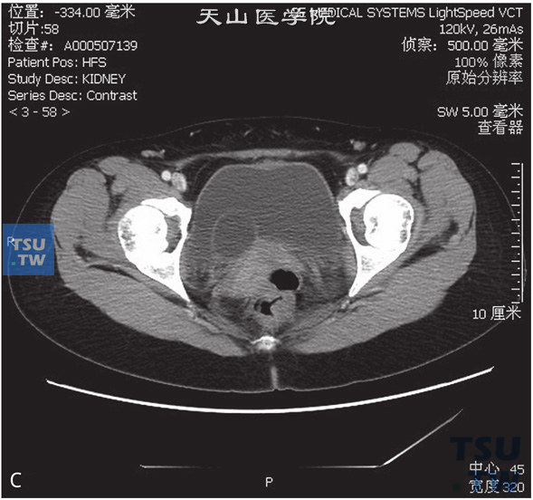 图C：CT，输尿管囊肿。女，28岁，肾积水，输尿管囊肿。右侧肾盂、肾盏及输尿管扩张、积水，右侧输尿管远段呈囊状突入膀胱内，分泌期未见对比剂进入右侧肾盂、肾盏及输尿管内