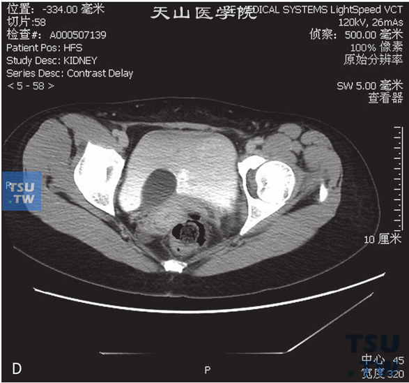 图D：CT，输尿管囊肿。女，28岁，肾积水，输尿管囊肿。右侧肾盂、肾盏及输尿管扩张、积水，右侧输尿管远段呈囊状突入膀胱内，分泌期未见对比剂进入右侧肾盂、肾盏及输尿管内