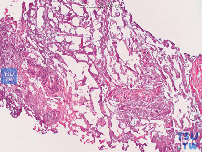 输尿管囊肿膨出电切标本，可见囊肿壁呈疏松的结缔组织