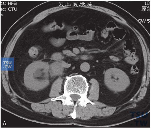 图A：CT，肾盂输尿管连接部狭窄。右侧肾盂输尿管结合部见软组织密度灶包绕，增强后可见明显强化。右侧肾盂输尿管结合部管腔狭窄，右侧肾盂、肾盏扩张、积水