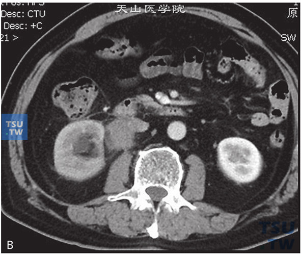 图B：CT，肾盂输尿管连接部狭窄。右侧肾盂输尿管结合部见软组织密度灶包绕，增强后可见明显强化。右侧肾盂输尿管结合部管腔狭窄，右侧肾盂、肾盏扩张、积水