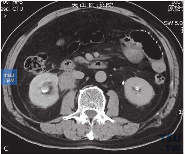 图c：CT，肾盂输尿管连接部狭窄。右侧肾盂输尿管结合部见软组织密度灶包绕，增强后可见明显强化。右侧肾盂输尿管结合部管腔狭窄，右侧肾盂、肾盏扩张、积水