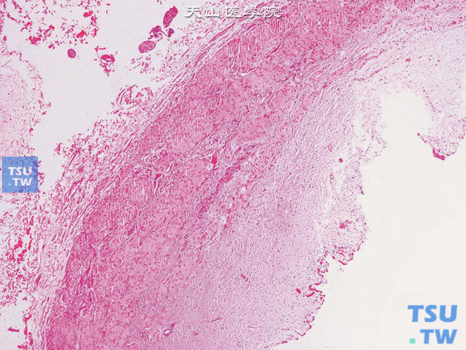 肾盂输尿管连接部狭窄，黏膜层及肌层可见纤维组织增生，被覆上皮脱落