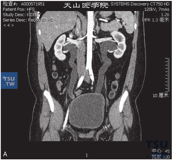 图B：CT，先天性巨输尿管。男，22岁，体检双肾积水。双侧肾盂、肾盏及输尿管扩张、积水，右侧输尿管下段管壁稍厚