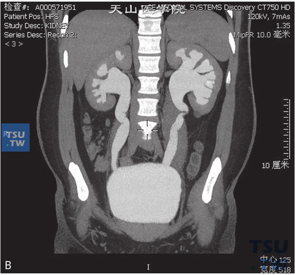 图D：CT，先天性巨输尿管。男，22岁，体检双肾积水。双侧肾盂、肾盏及输尿管扩张、积水，右侧输尿管下段管壁稍厚