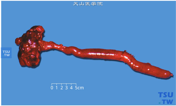 输尿管先天性异常：囊肿、狭窄、巨输尿管