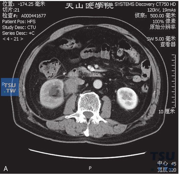 图A：CT，肾盂输尿管连接部肉芽肿性炎。男，37岁，血尿1个月余。右侧肾盂、肾盏扩张、积水。右侧肾盂输尿管结合部见软组织密度肿块包绕，边缘毛糙，增强后可见强化，分泌期对比剂未能进入输尿管