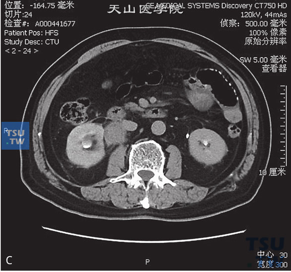 图C：CT，肾盂输尿管连接部肉芽肿性炎。男，37岁，血尿1个月余。右侧肾盂、肾盏扩张、积水。右侧肾盂输尿管结合部见软组织密度肿块包绕，边缘毛糙，增强后可见强化，分泌期对比剂未能进入输尿管