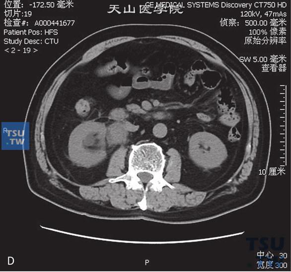 图D：CT，肾盂输尿管连接部肉芽肿性炎。男，37岁，血尿1个月余。右侧肾盂、肾盏扩张、积水。右侧肾盂输尿管结合部见软组织密度肿块包绕，边缘毛糙，增强后可见强化，分泌期对比剂未能进入输尿管