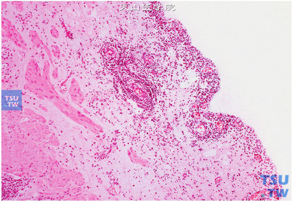 输尿管黏膜非特异性慢性炎，黏膜固有层可见慢性炎细胞浸润，被覆上皮脱落
