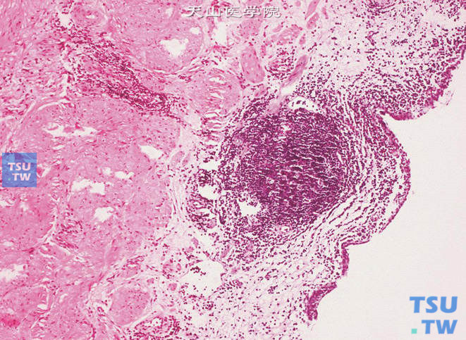 输尿管黏膜慢性炎，伴淋巴滤泡形成