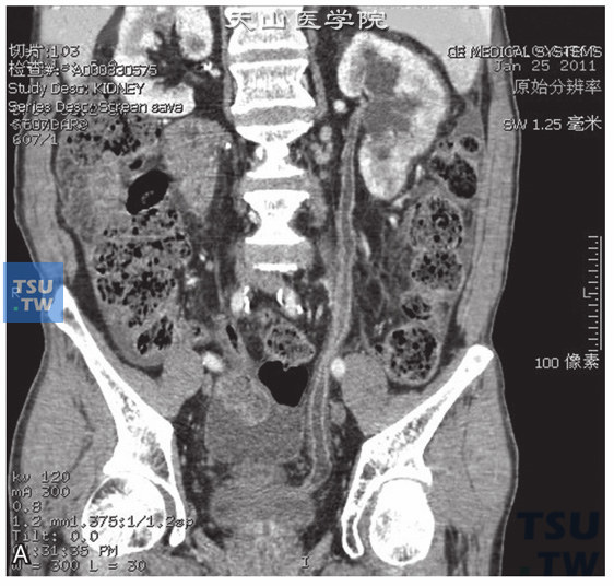 图A：CT，输尿管结核