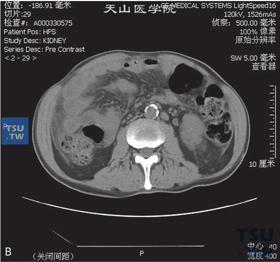 图B：CT，输尿管结核