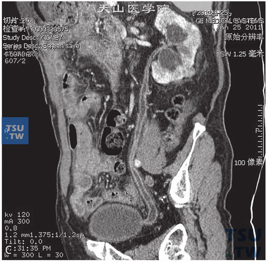 图C：CT，输尿管结核