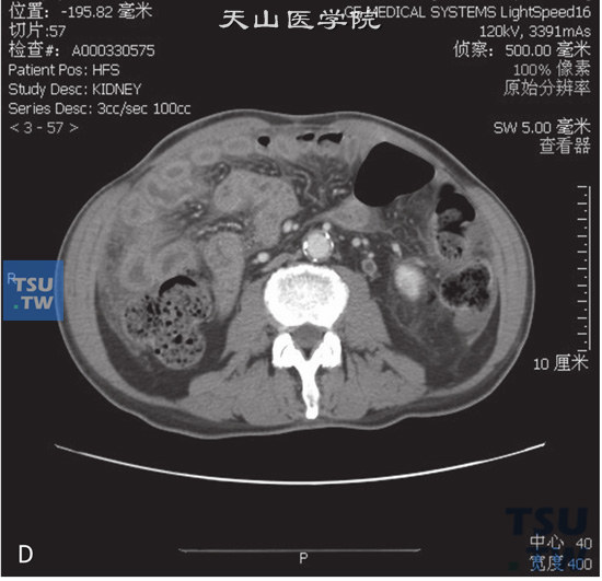 图d：CT，输尿管结核