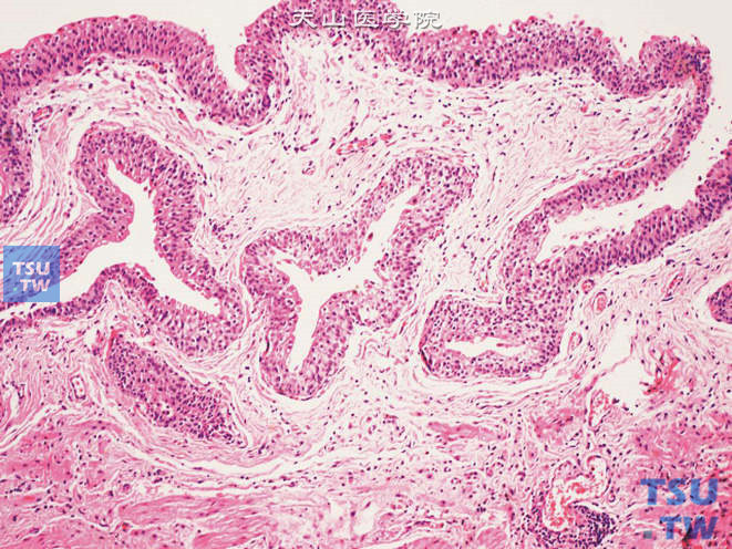 囊腺性输尿管炎。示固有层中的囊性结构由黏膜被覆上皮下陷所致