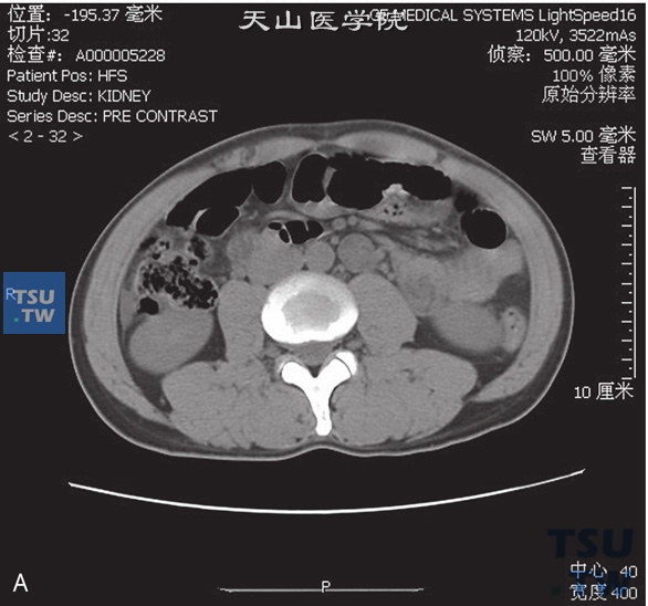 图A：CT，输尿管多发性息肉。男，75岁，体检发现右肾积水。左侧输尿管中上段管腔内见多发条状软组织密度灶，边缘清晰，分泌期可见多发充盈缺损。左侧肾盂、肾盏及上段输尿管扩张积水