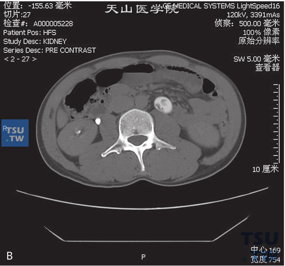 图B：CT，输尿管多发性息肉。男，75岁，体检发现右肾积水。左侧输尿管中上段管腔内见多发条状软组织密度灶，边缘清晰，分泌期可见多发充盈缺损。左侧肾盂、肾盏及上段输尿管扩张积水