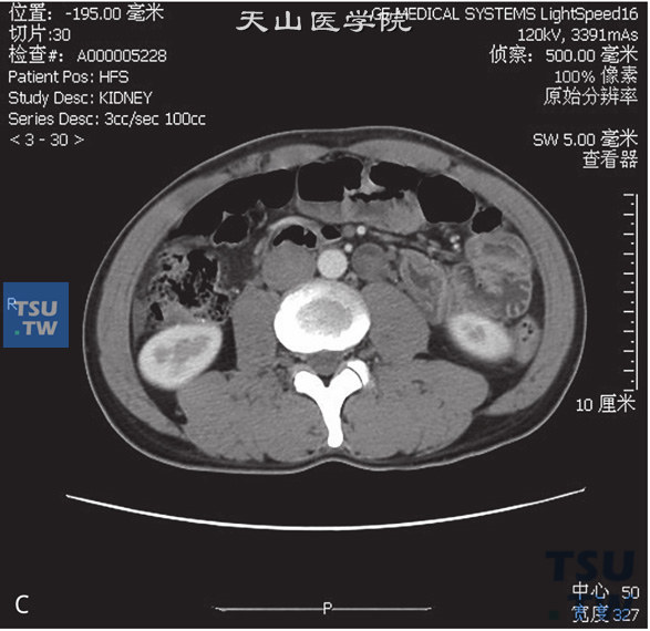 图c：CT，输尿管多发性息肉。男，75岁，体检发现右肾积水。左侧输尿管中上段管腔内见多发条状软组织密度灶，边缘清晰，分泌期可见多发充盈缺损。左侧肾盂、肾盏及上段输尿管扩张积水