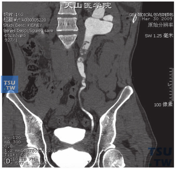 图D：CT，输尿管多发性息肉。男，75岁，体检发现右肾积水。左侧输尿管中上段管腔内见多发条状软组织密度灶，边缘清晰，分泌期可见多发充盈缺损。左侧肾盂、肾盏及上段输尿管扩张积水