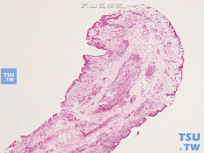 输尿管纤维上皮性息肉。由疏松结缔组织和血管构成轴心，被覆尿路上皮