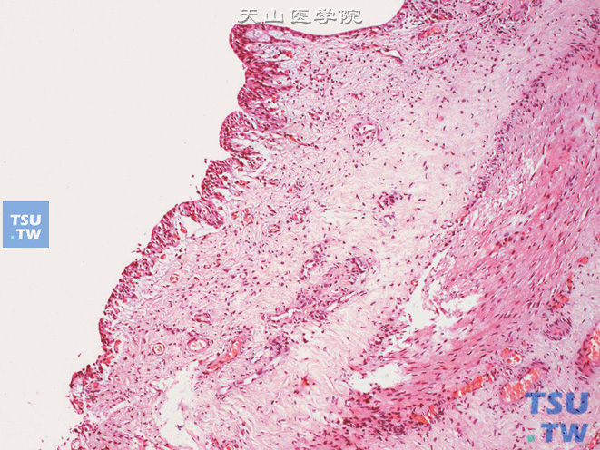输尿管纤维上皮性息肉。上图高倍，示被覆尿路上皮，局部上皮层变薄