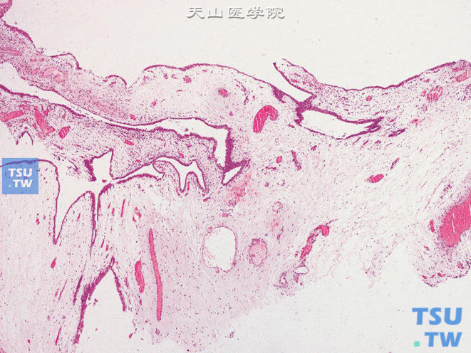 输尿管纤维上皮性息肉，多发性