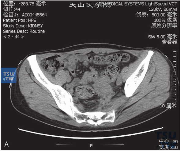 图A：CT，输尿管子宫内膜异位。女，47岁，子宫内膜异位病史，左下腹痛。左侧髂内动脉旁见不规则软组织密度灶，与髂内动脉及邻近子宫底分界不清，增强后可见强化