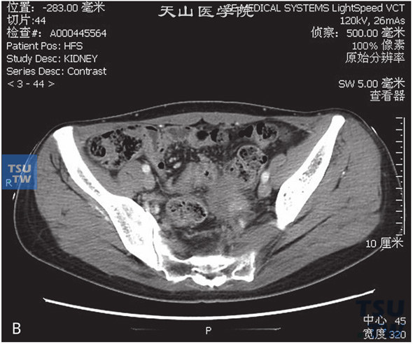 图B：CT，输尿管子宫内膜异位。女，47岁，子宫内膜异位病史，左下腹痛。左侧髂内动脉旁见不规则软组织密度灶，与髂内动脉及邻近子宫底分界不清，增强后可见强化