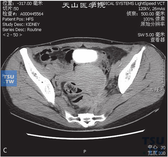 图C：CT，输尿管子宫内膜异位。女，47岁，子宫内膜异位病史，左下腹痛。左侧髂内动脉旁见不规则软组织密度灶，与髂内动脉及邻近子宫底分界不清，增强后可见强化