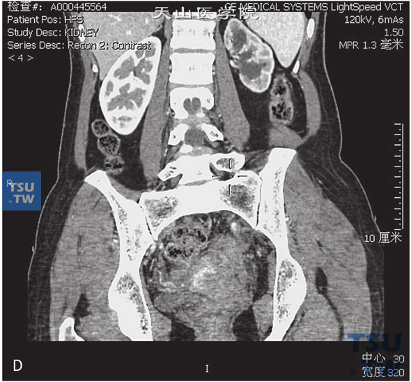 图D：CT，输尿管子宫内膜异位。女，47岁，子宫内膜异位病史，左下腹痛。左侧髂内动脉旁见不规则软组织密度灶，与髂内动脉及邻近子宫底分界不清，增强后可见强化