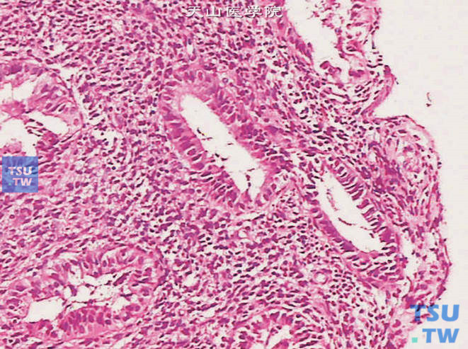 输尿管子宫内膜异位，子宫内膜腺体及间质位于黏膜层