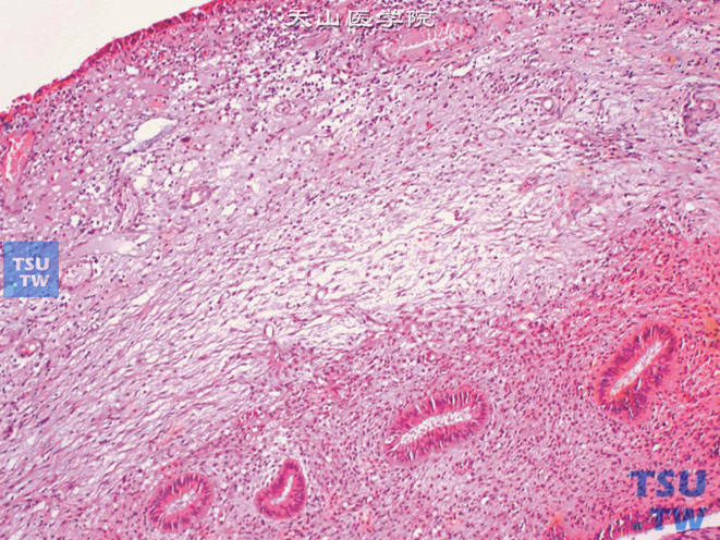输尿管黏膜子宫内膜异位，可见数个子宫内膜腺体