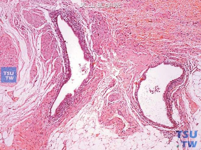 输尿管管壁子宫内膜异位，可见子宫内膜腺体及少许间质，伴出血