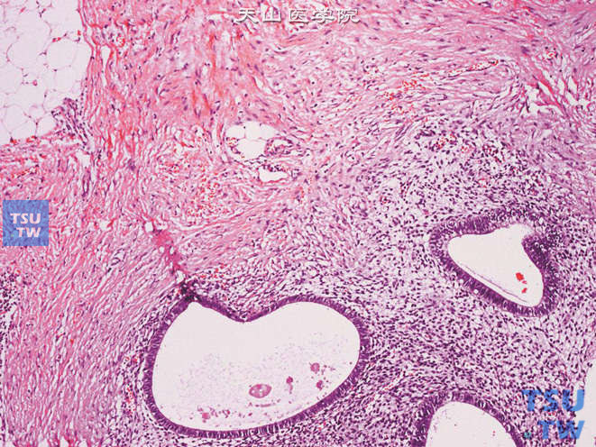 输尿管子宫内膜异位，可见子宫内膜腺体及间质位于输尿管肌层及周围脂肪组织中