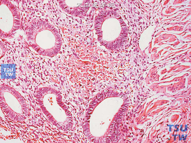 输尿管子宫内膜异位，可见子宫内膜腺体及间质位于输尿管肌层，间质可见出血及少量含铁血黄素