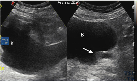 输尿管下段癌超声图像特点：输尿管膀胱壁段入膀胱口处可见低回声团块（箭头指示），并向膀胱腔内凸出，患肾及输尿管全长重度扩张积水