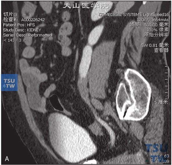 图A：CT，输尿管尿路上皮癌。女，63岁，血尿。左侧输尿管下段管腔内见软组织密度灶充盈，增强后可见强化，其近端输尿管扩张积水，分泌期左侧输尿管未见对比剂充盈