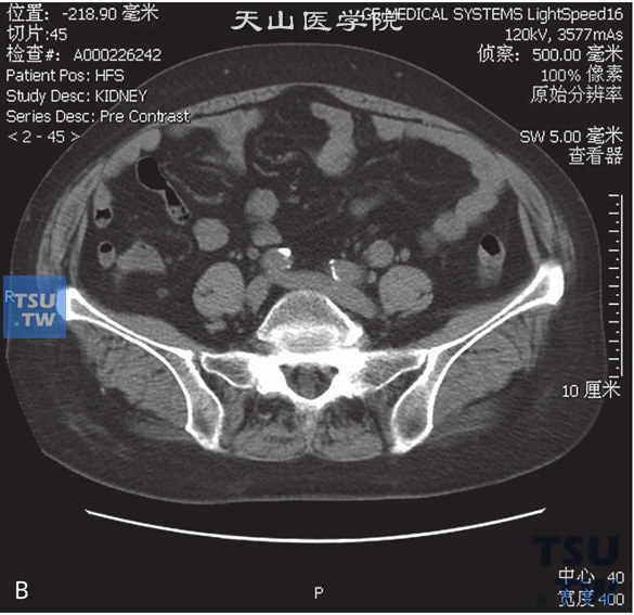 图B：CT，输尿管尿路上皮癌。女，63岁，血尿。左侧输尿管下段管腔内见软组织密度灶充盈，增强后可见强化，其近端输尿管扩张积水，分泌期左侧输尿管未见对比剂充盈
