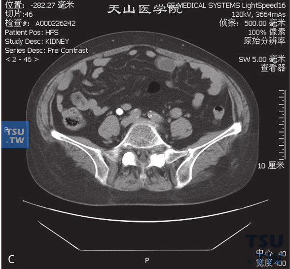 图C：CT，输尿管尿路上皮癌。女，63岁，血尿。左侧输尿管下段管腔内见软组织密度灶充盈，增强后可见强化，其近端输尿管扩张积水，分泌期左侧输尿管未见对比剂充盈