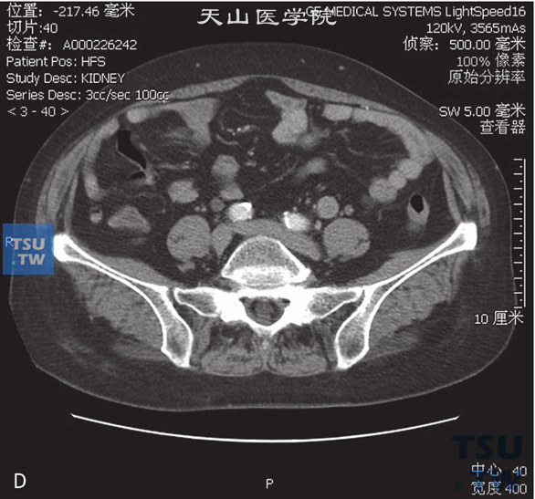 图D：CT，输尿管尿路上皮癌。女，63岁，血尿。左侧输尿管下段管腔内见软组织密度灶充盈，增强后可见强化，其近端输尿管扩张积水，分泌期左侧输尿管未见对比剂充盈