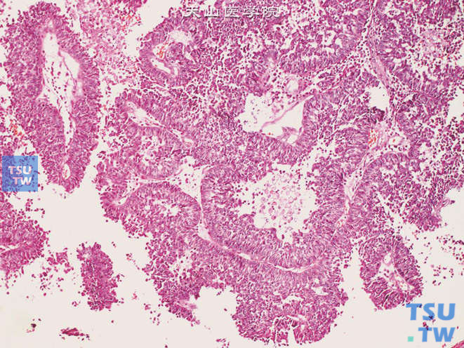 输尿管乳头状尿路上皮癌，示分支的乳头状结构