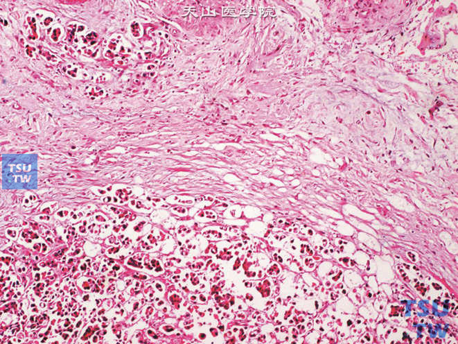输尿管浸润性高级别尿路上皮癌，伴腺样分化，浸润输尿管周围脂肪及小脉管